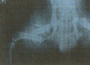Radiografia Fractura de Femur